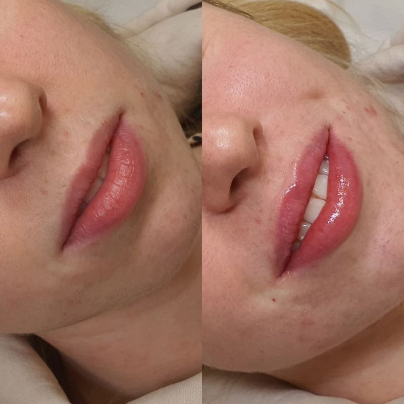 Takroni Clinic - Lip Fillers Before After