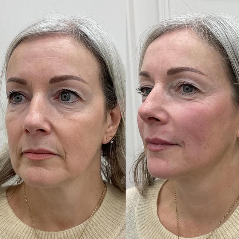 Takroni Clinic - Full Face Transformation Before After