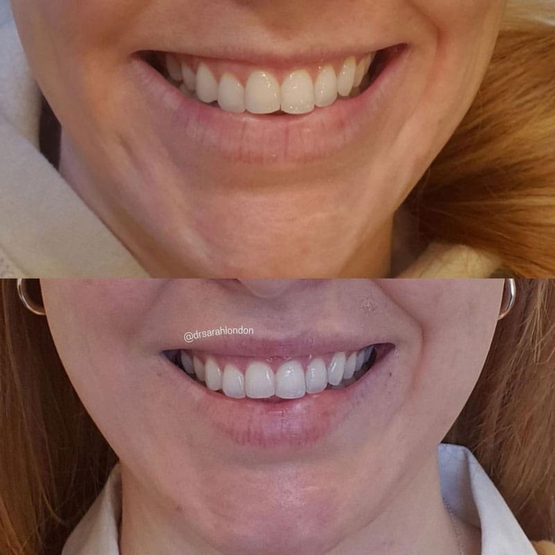 Takroni Clinic - Gummy Smile Lip Flip Reduction Before After