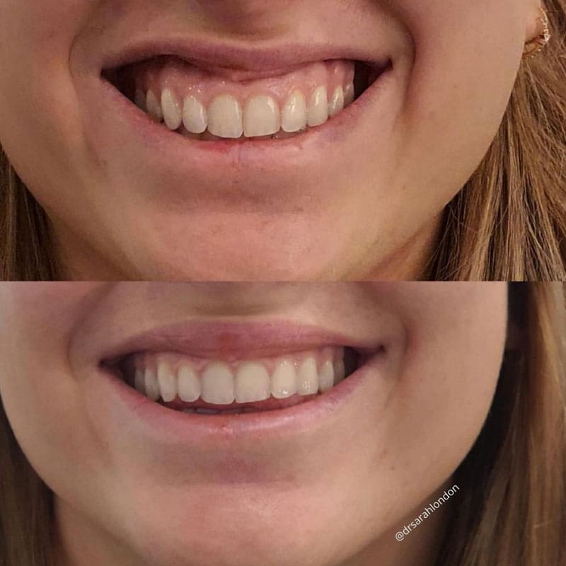 Takroni Clinic - Gummy Smile Lip Flip Reduction Before After