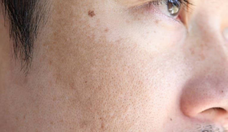 Takroni Clinic - Melasma