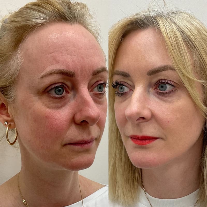 Takroni Clinic - Morpheus 8 Before After