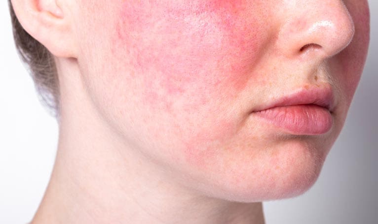 Takroni Clinic - Redness rosacea